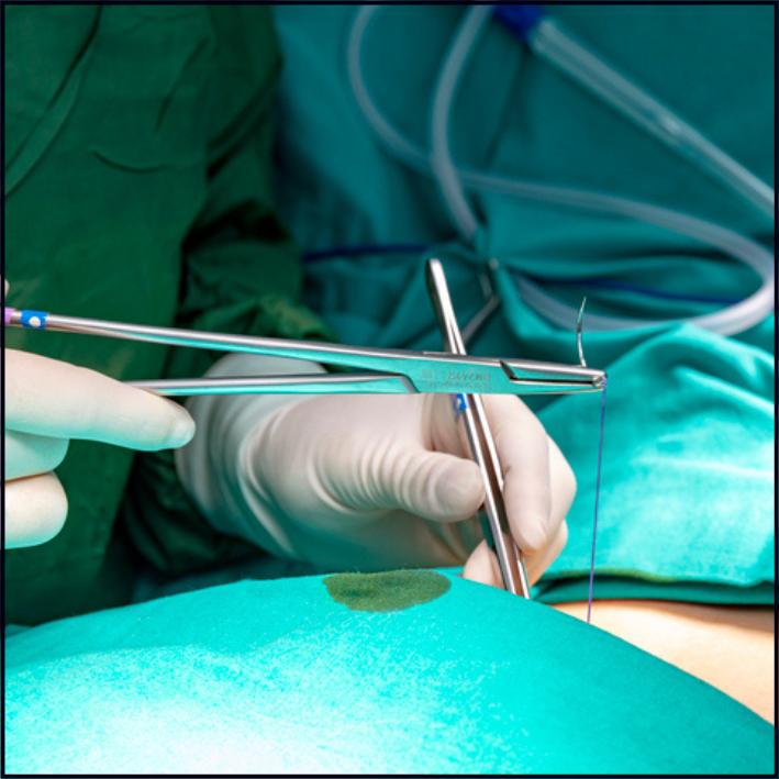 Durable surgical sutures designed for secure wound closure in various types of surgeries.