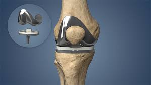 EXTREMITY SET - KNEE ARTHROPLASTY